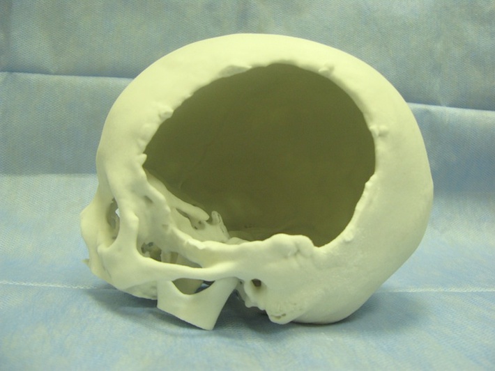 Краниопластика: применение 3D-печати для пластики черепа