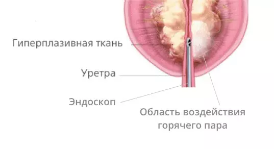 Изображение 1 для поста «Медицина и Фармацевтика: В российских клиниках начали лечить аденому простаты с помощью пара»