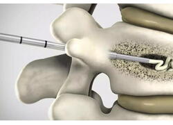Медицинский НИИ сделал прорыв в исследовании костной хирургии с новым костным цементом